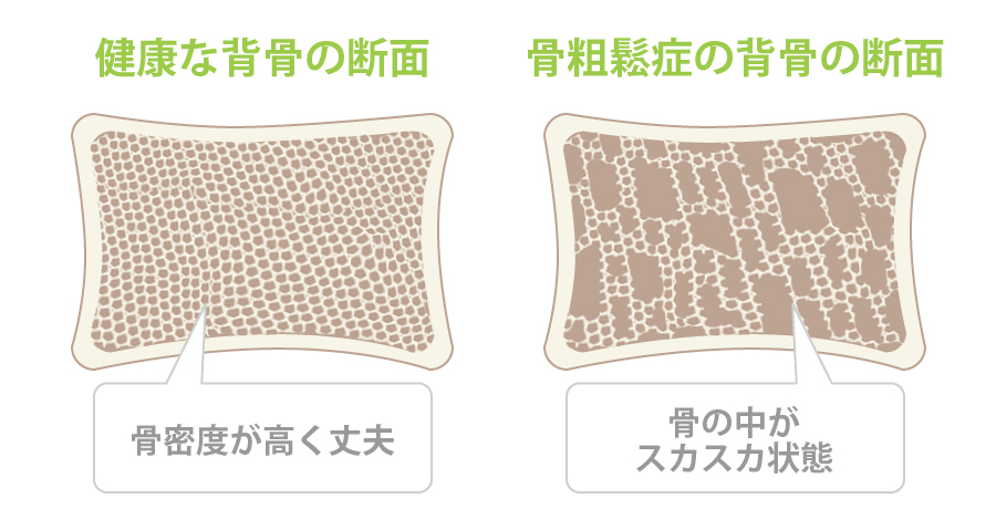 タカハラ整形外科クリニック 骨粗鬆症の運動療法