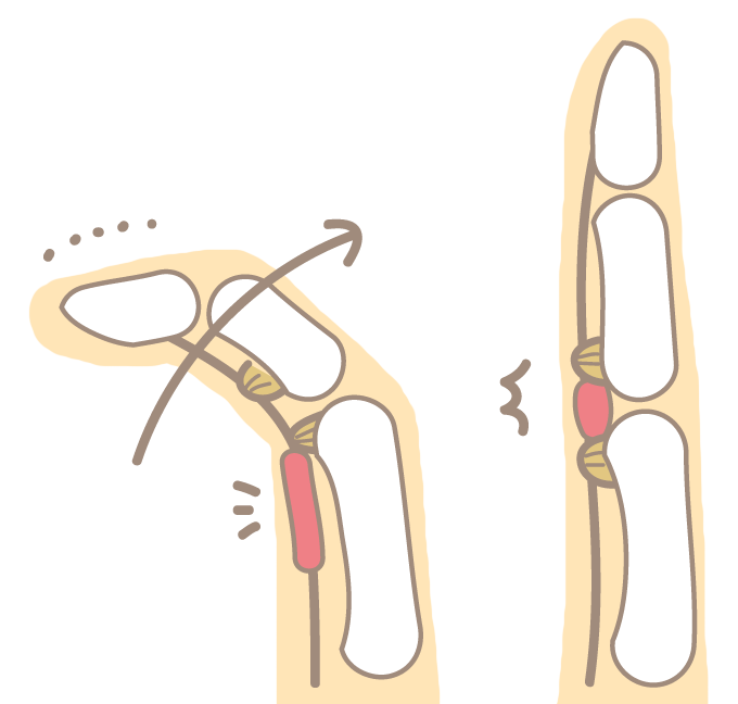 ばね指（弾発指）をご存知ですか？