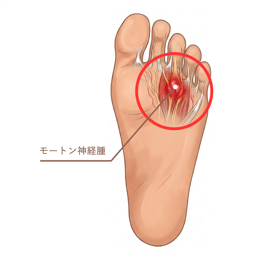 モートン病